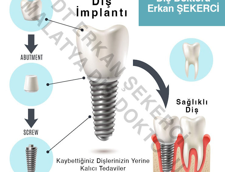 malatya-diş-implantı-