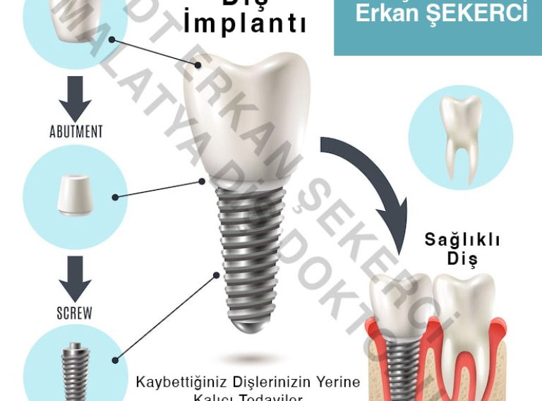 malatya-diş-implantı-